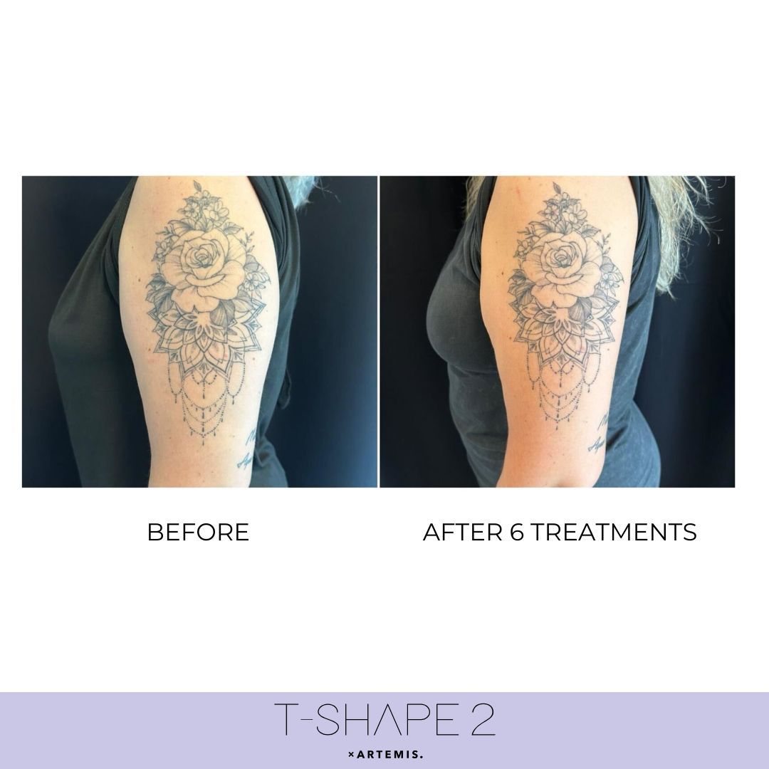 Before and after photos of an arm tattoo after 6 treatments. Tattoo appears less defined in the after photo.
