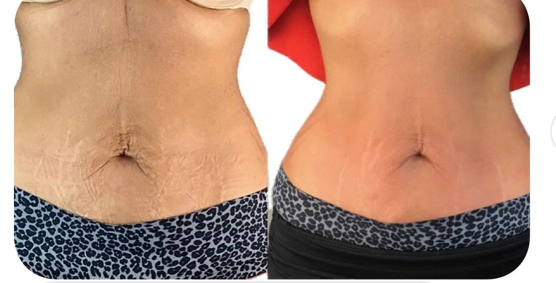 Side-by-side comparison of a torso showing skin changes after a procedure; skin appears tighter and toned on the right.