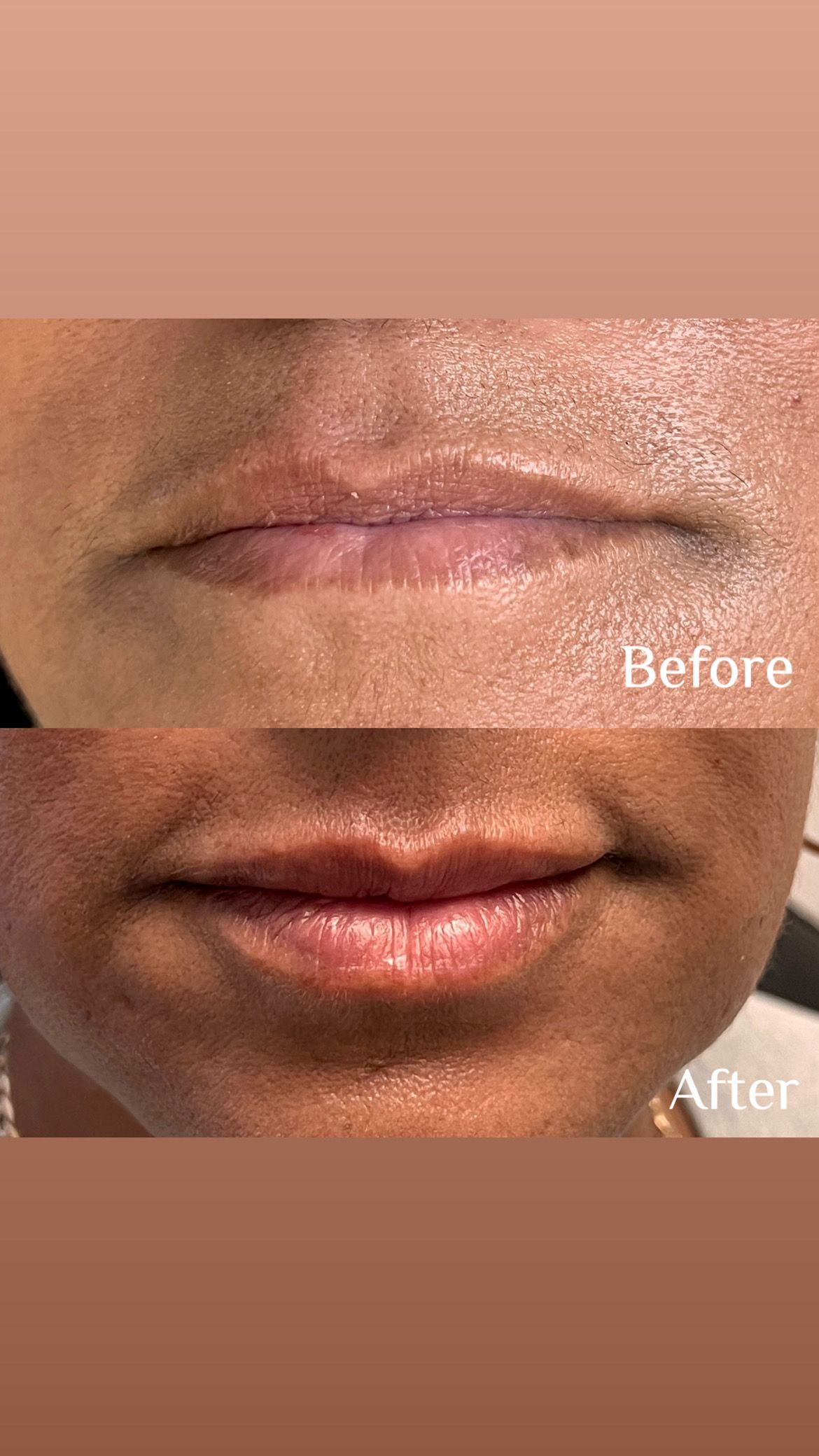 A before and after photo of a woman 's lips.