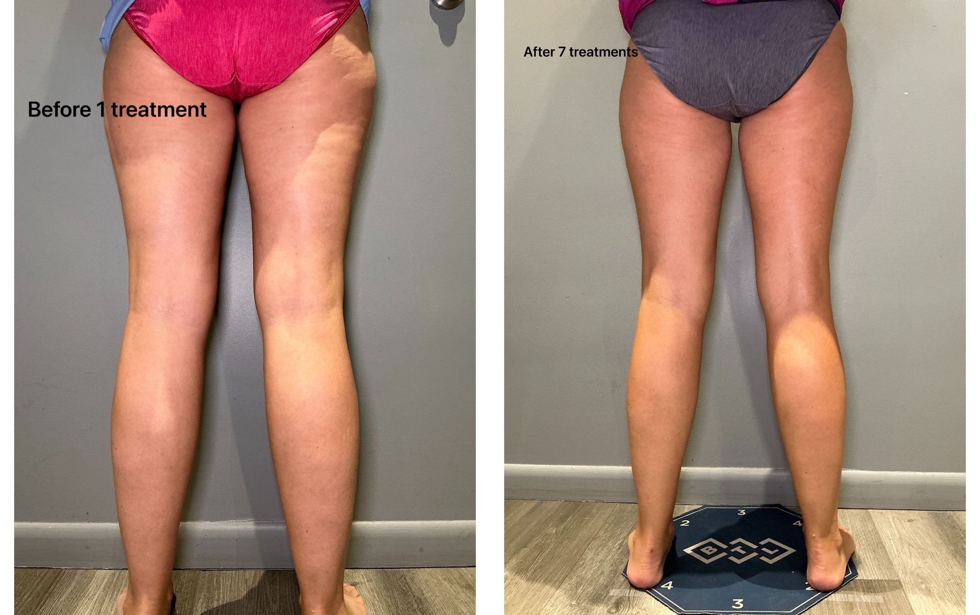 Side-by-side comparison of legs before and after treatment, showing cellulite reduction.