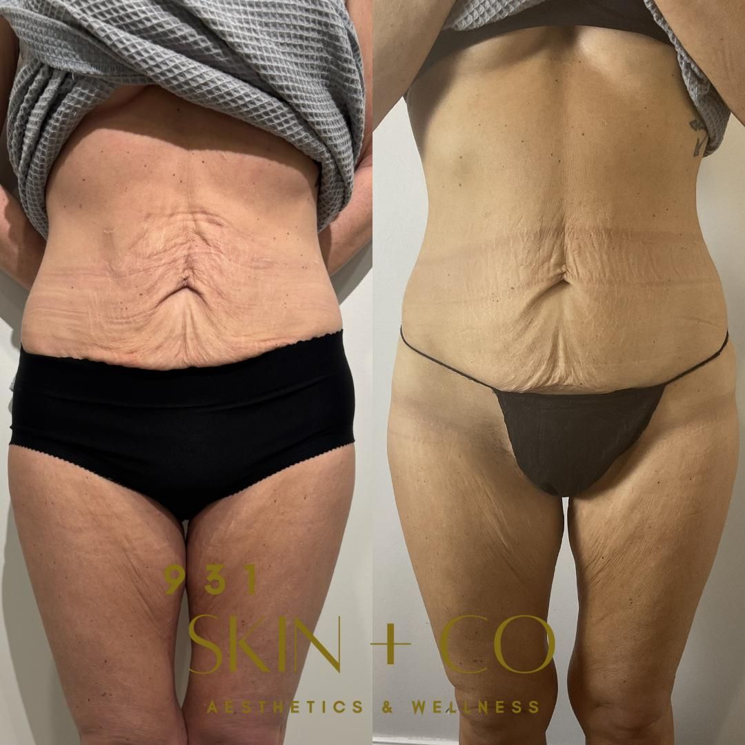 Side-by-side comparison of a person's abdomen before and after a cosmetic procedure. Skin is visible.