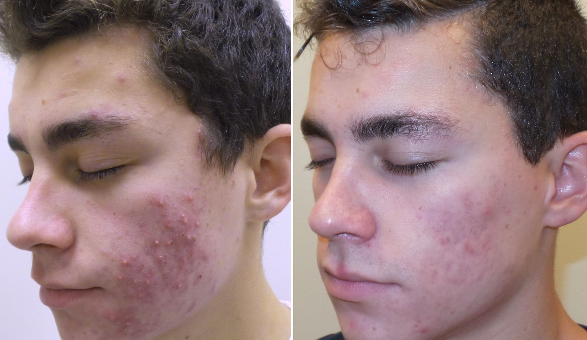 A before and after photo of a young man with acne on his face.