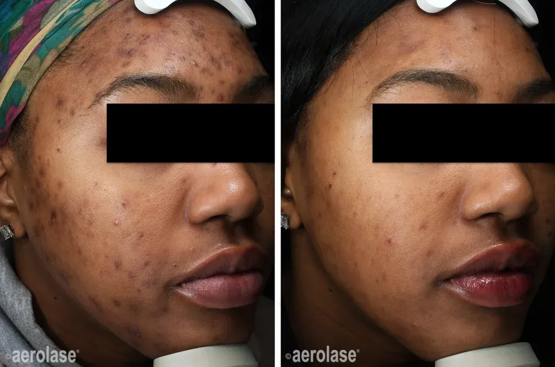 Side-by-side close-up of a woman’s face before and after acne treatment, showing clearer skin on the right.