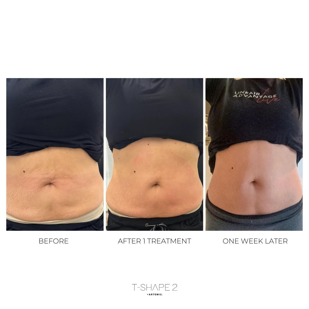 Three abdominal views: before, after one treatment, and one week later, showing reduced fat.