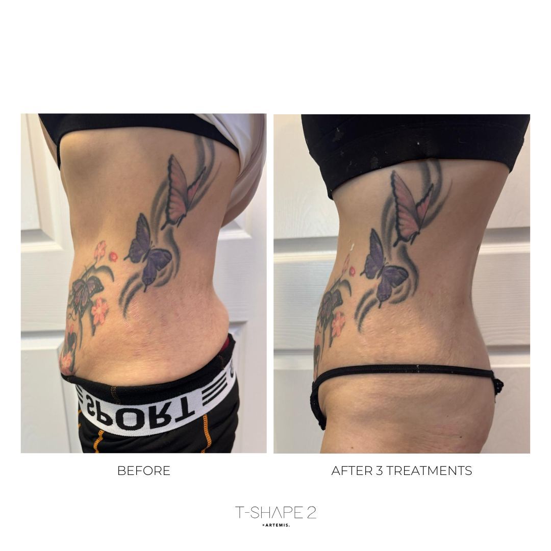 Side-by-side comparison: body before and after three treatments. Visible side abdominal area with a butterfly tattoo.