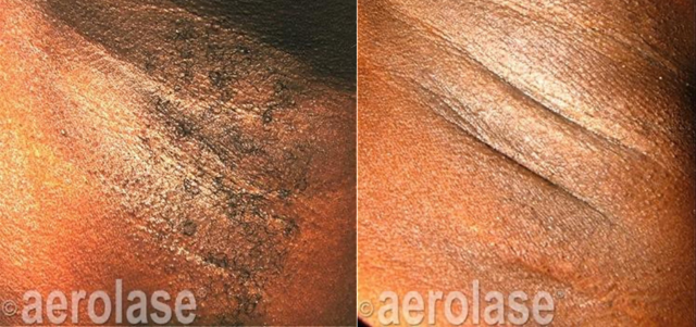 A before and after photo of a person 's neck with a tattoo on it.