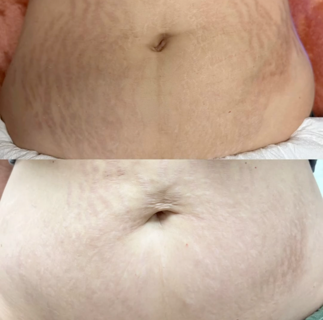 A before and after photo of a woman 's stomach with stretch marks.