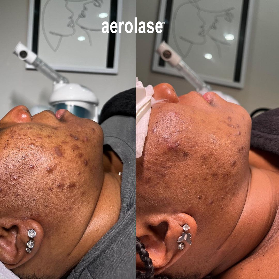 Hyperpigmentation with Aerolase