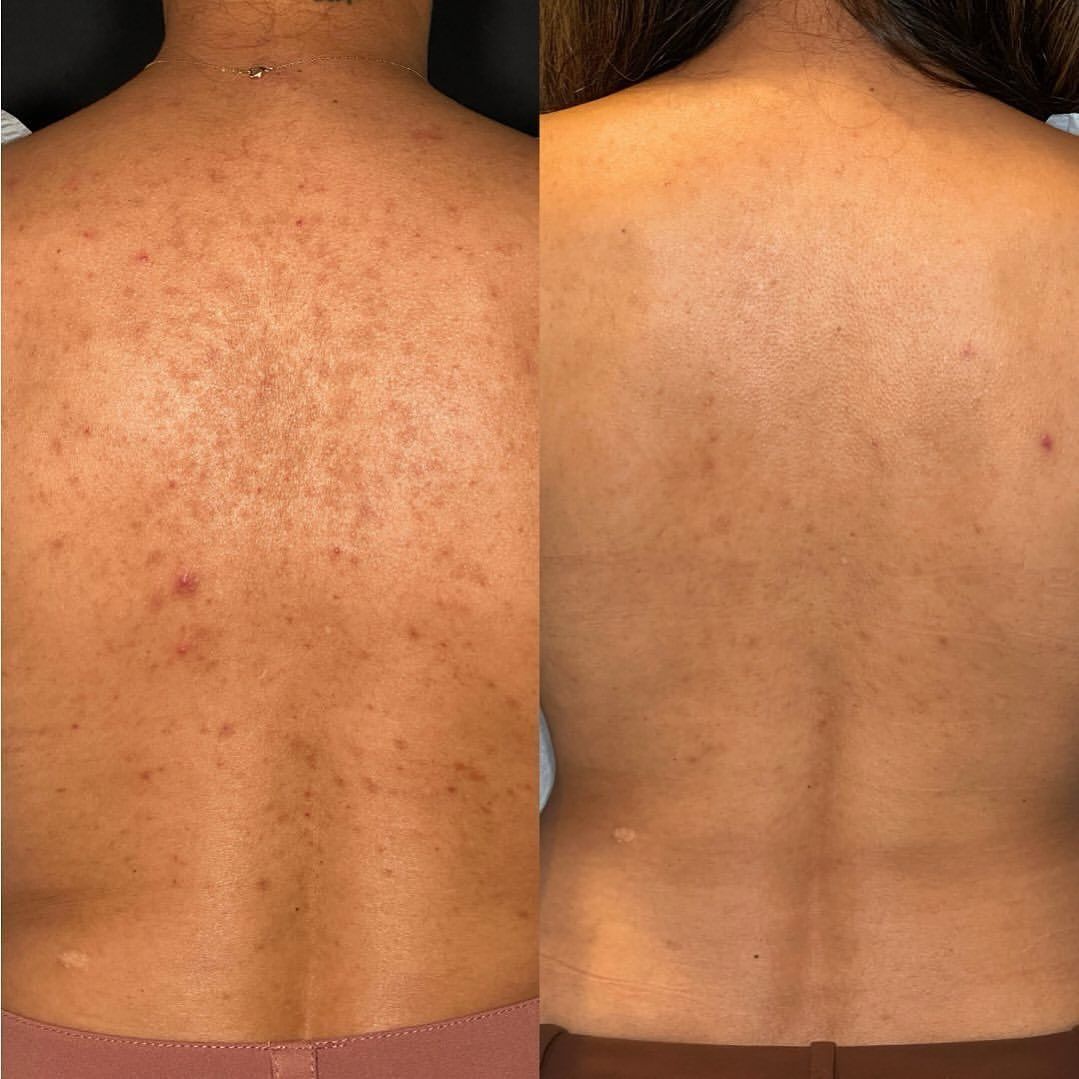 A before and after picture of a woman 's back with acne.