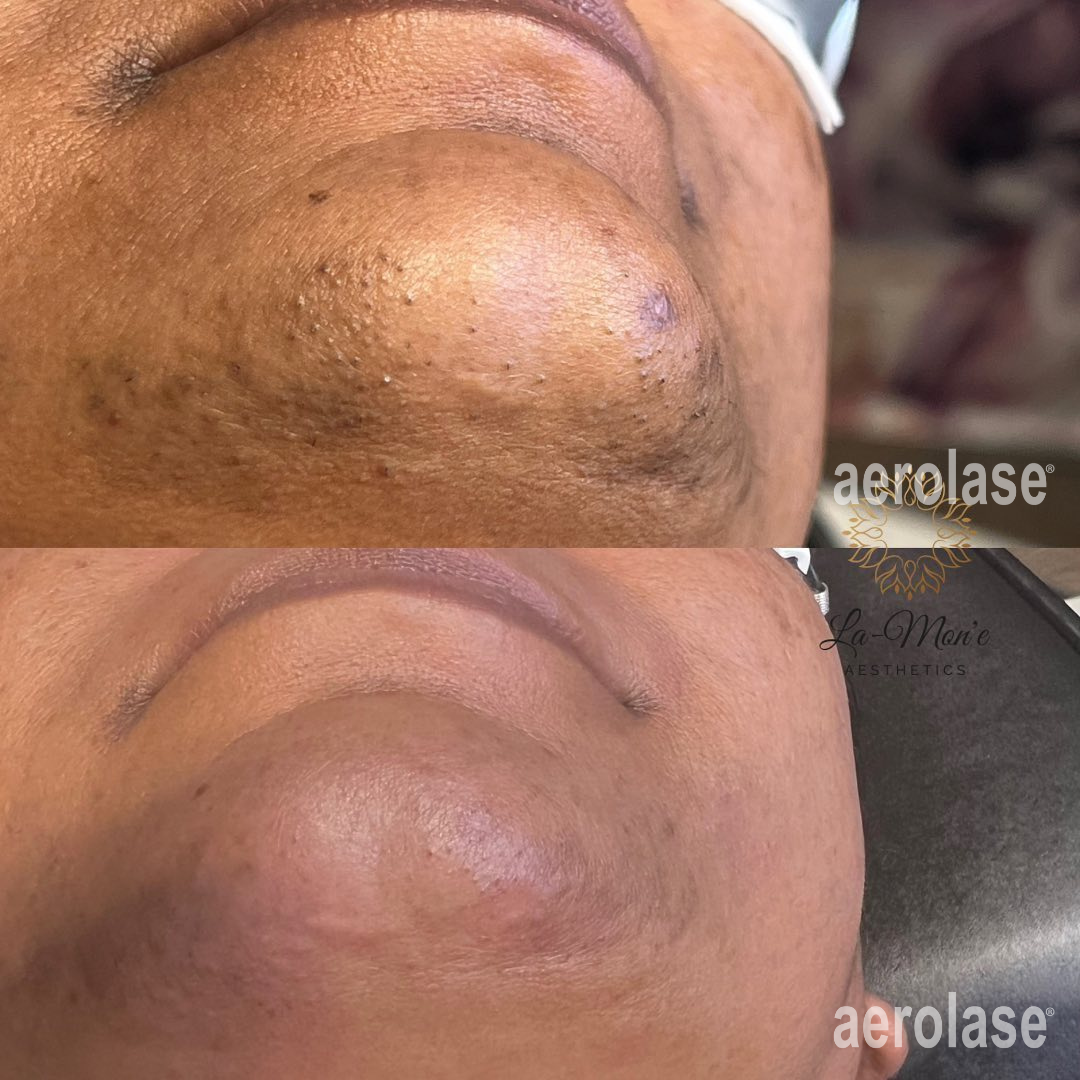 Before-and-after close-up of a chin treatment, showing reduced dark spots and smoother skin.