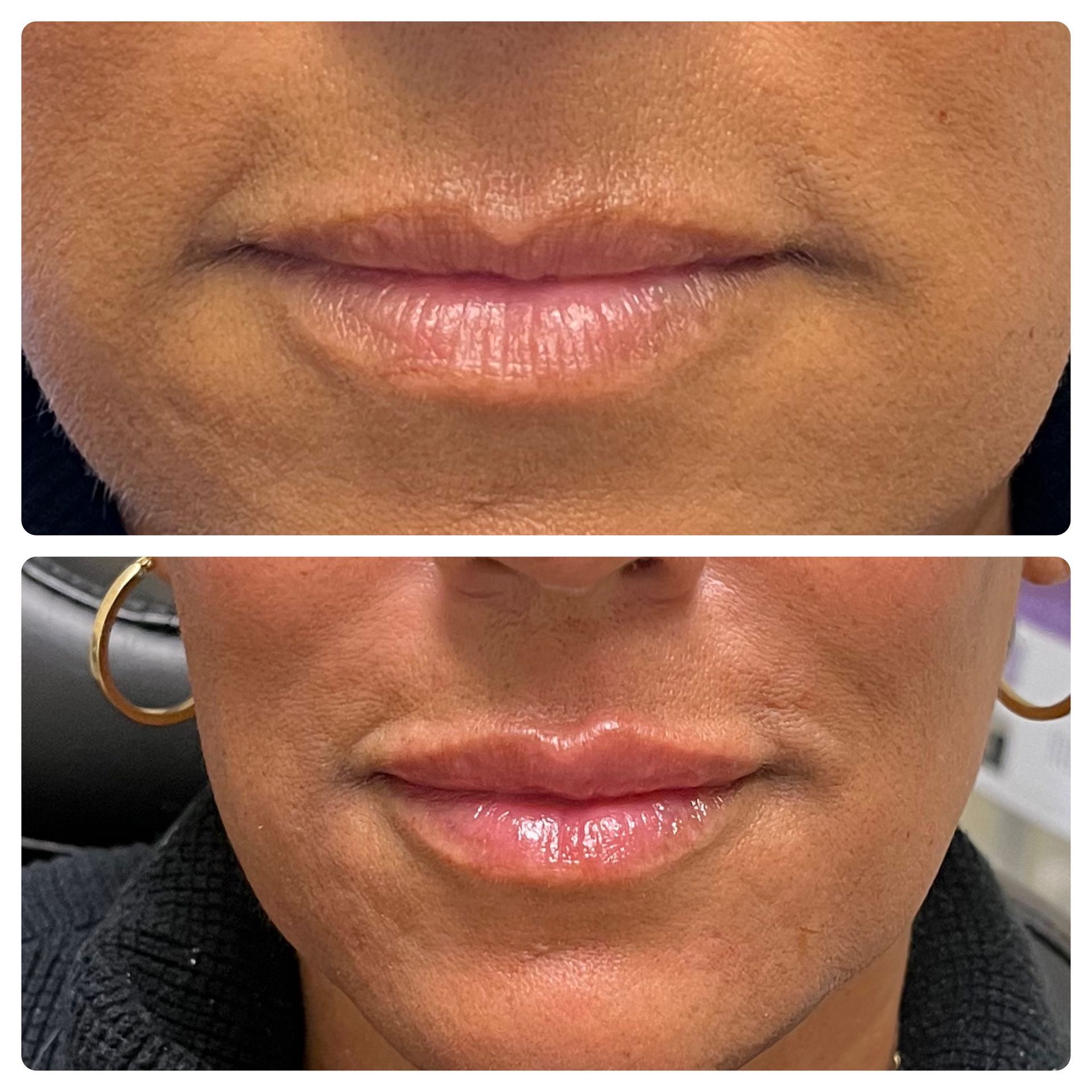 A before and after photo of a woman 's lips.