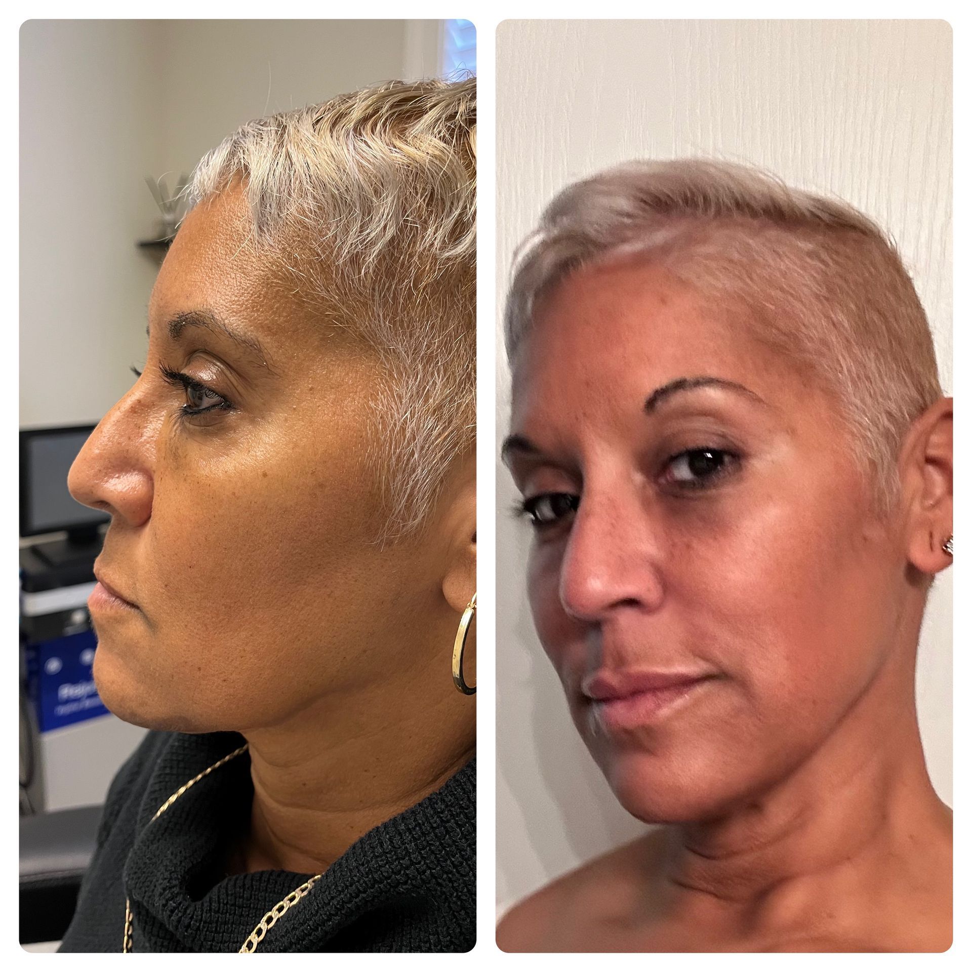 A before and after photo of a woman 's face.