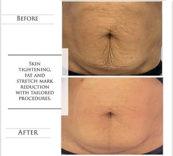 Before and after images of a stomach; showing skin tightening and stretch mark reduction.