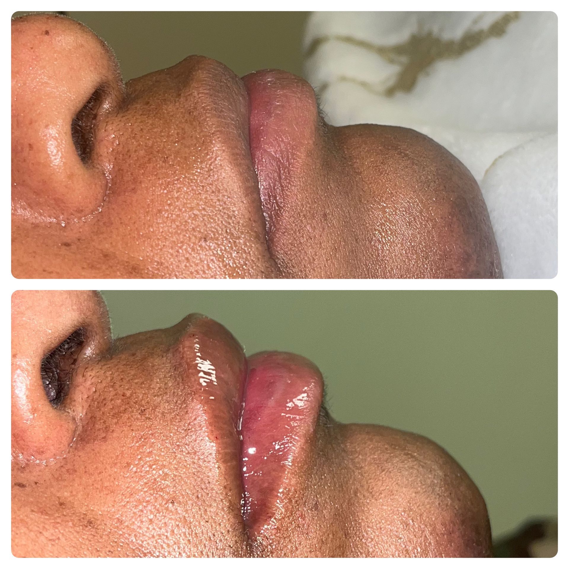 A before and after photo of a woman 's lips.