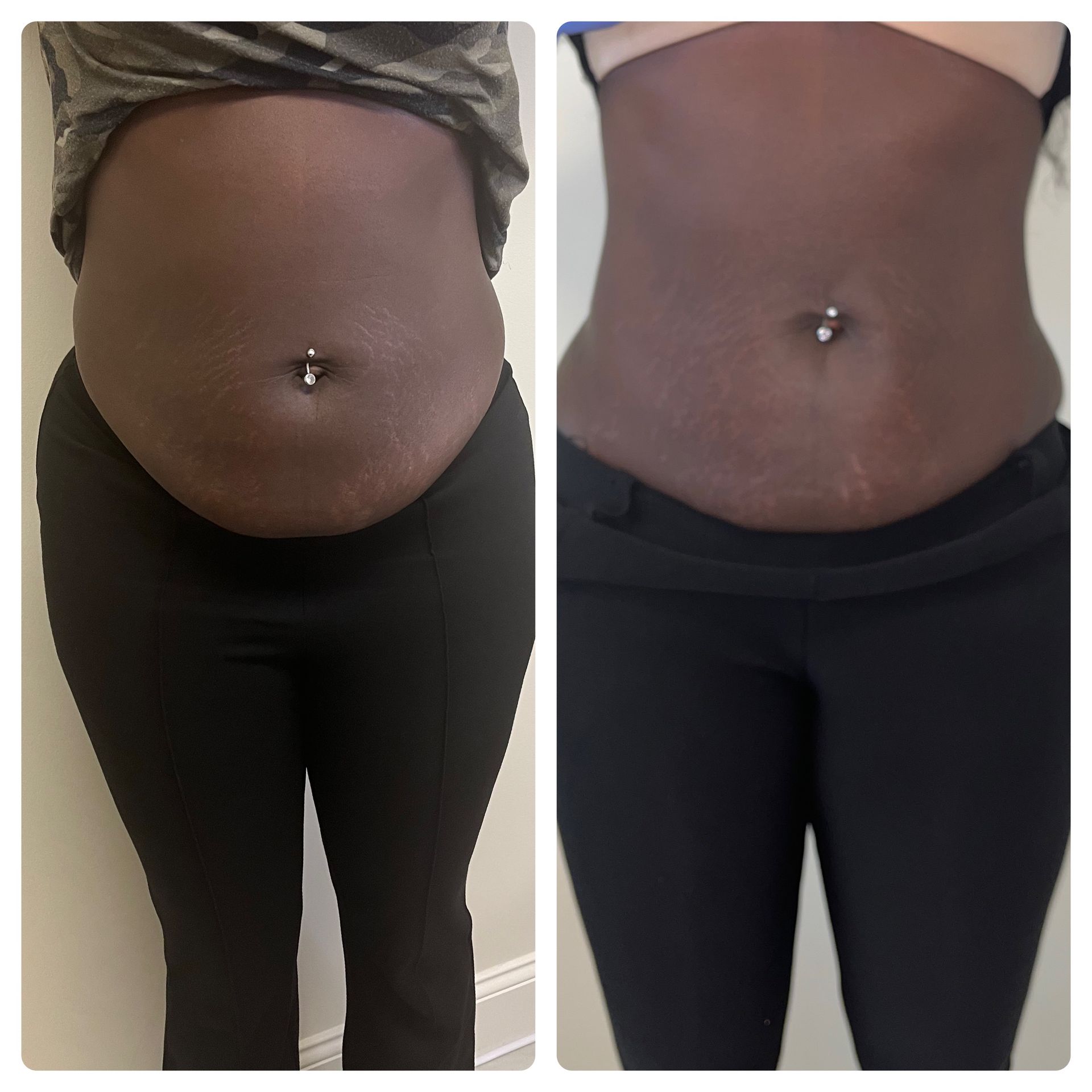 A before and after photo of a woman 's belly
