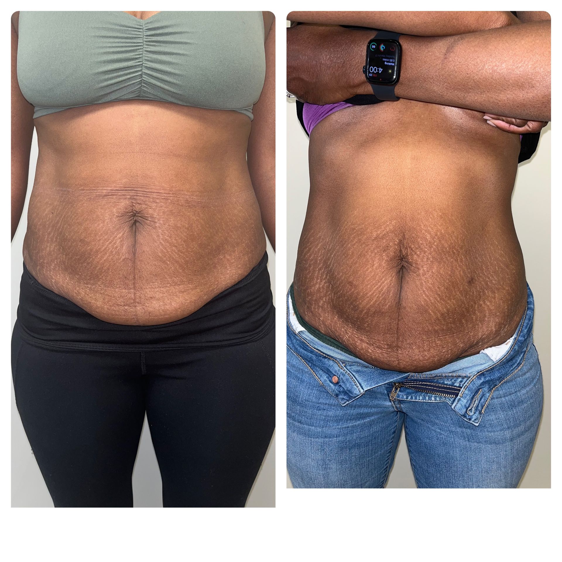 A before and after picture of a woman 's stomach.