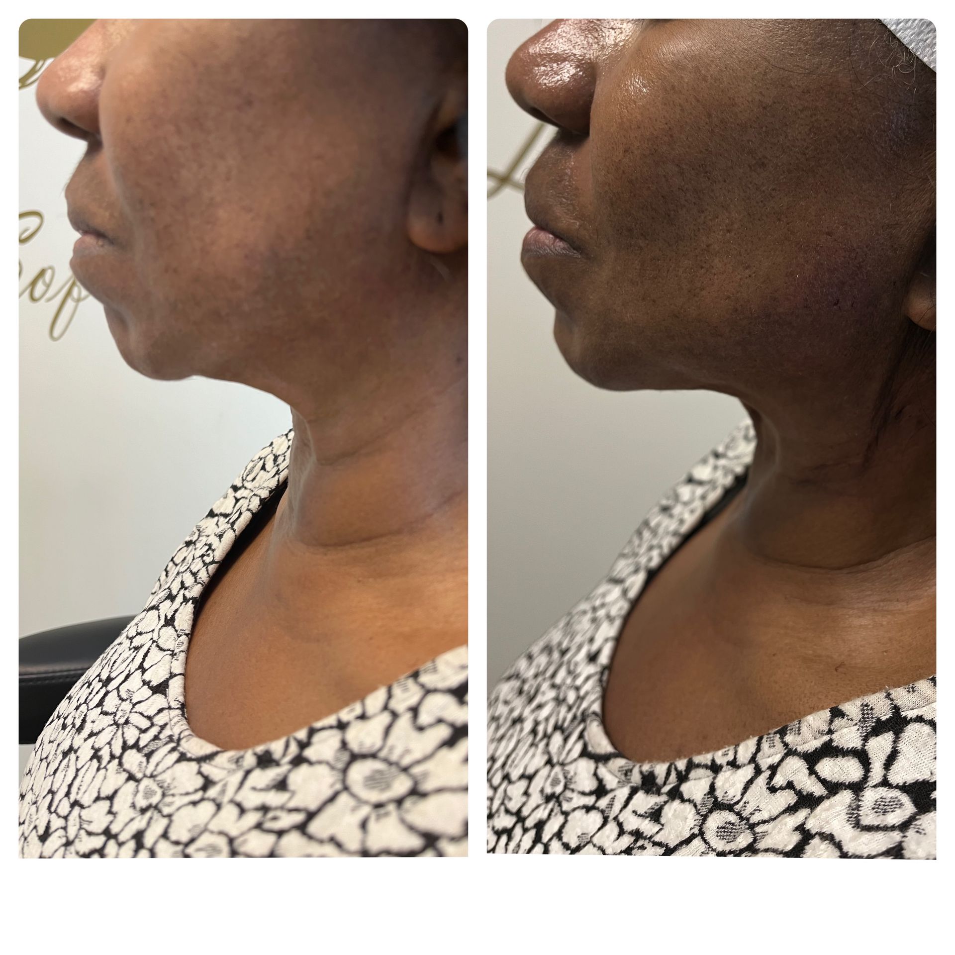 A before and after photo of a woman 's neck and face