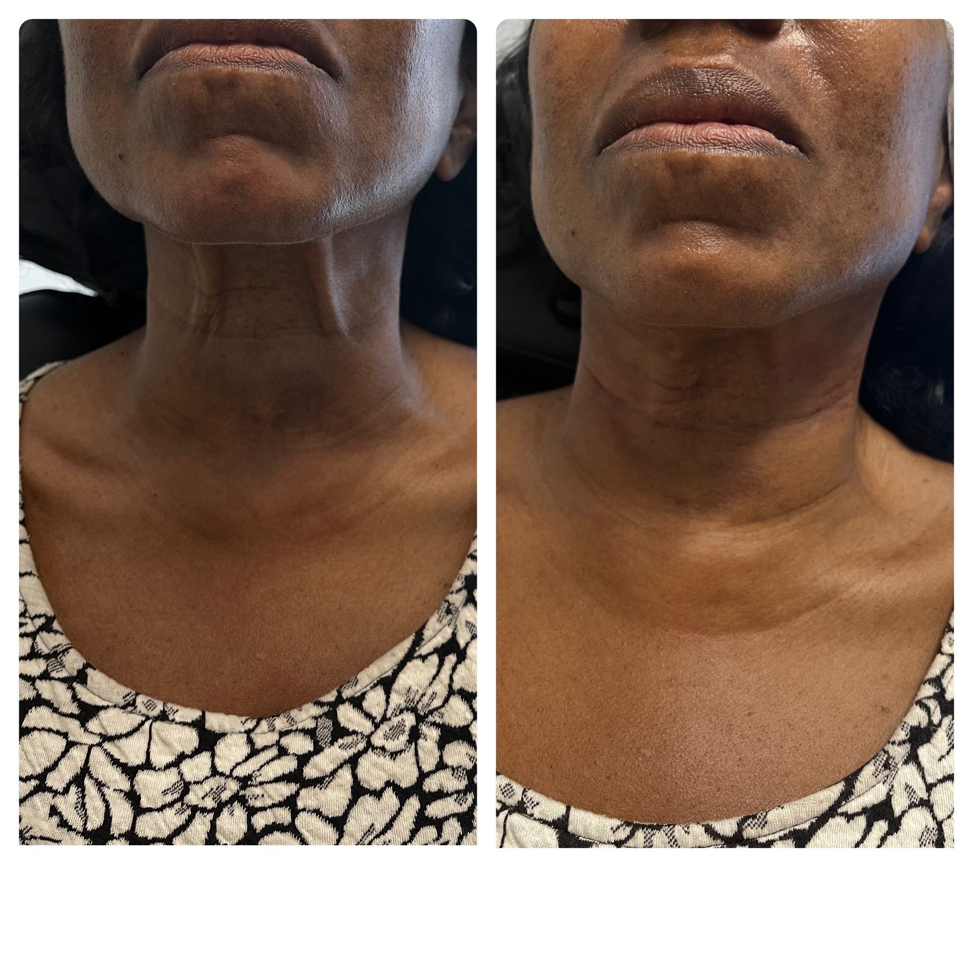 A before and after photo of a woman 's neck and neckline