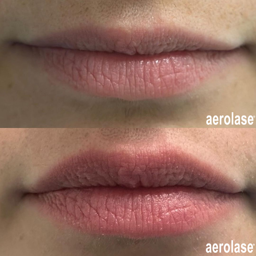 A before and after photo of a woman 's lips.