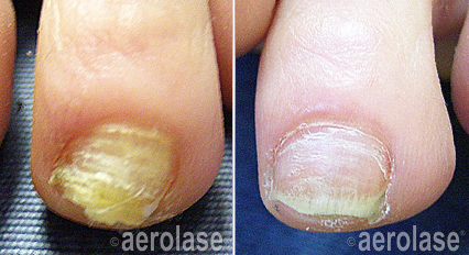 A before and after photo of a person 's toenails.