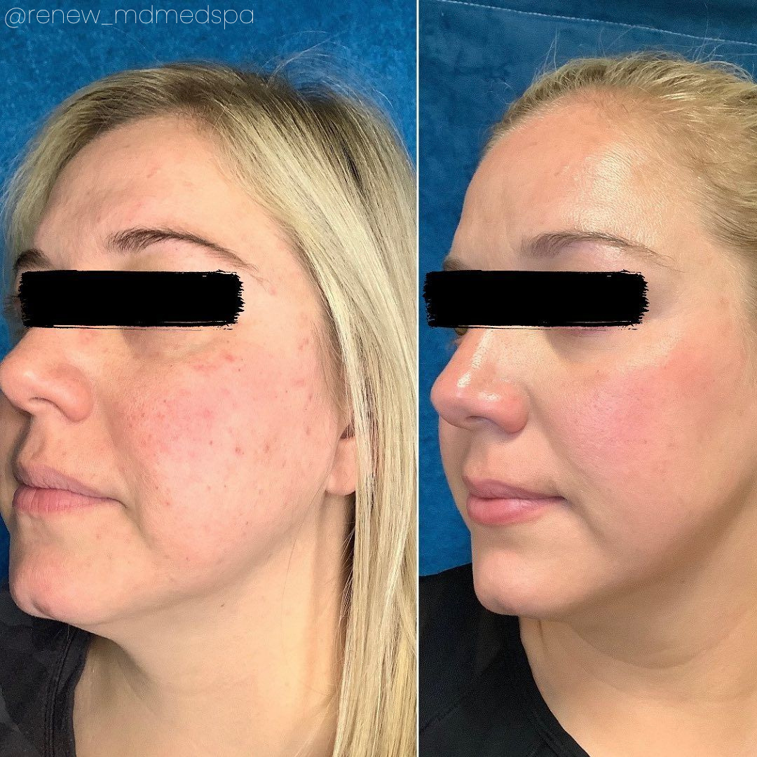 A before and after photo of a woman 's face