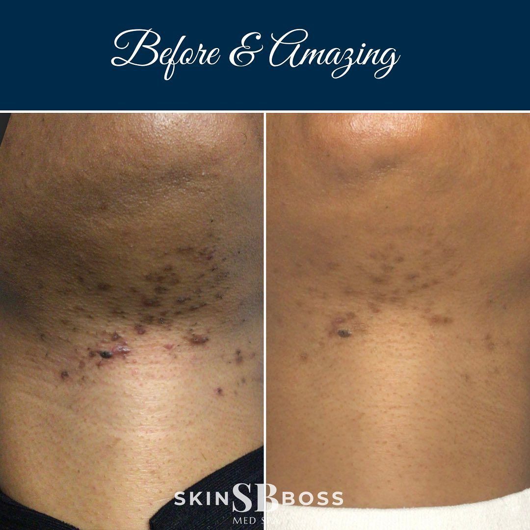 A before and after photo of a person 's neck