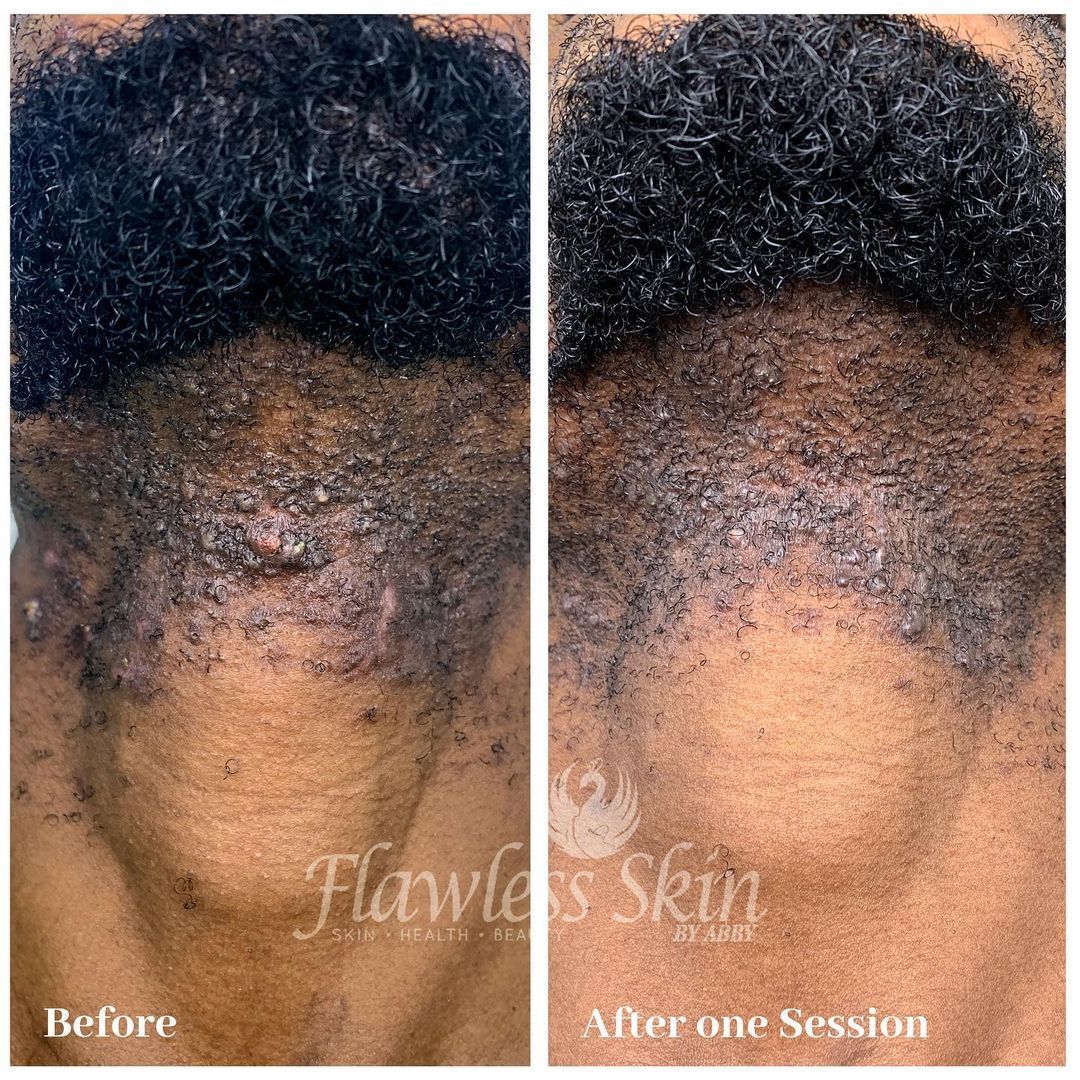 A before and after photo of a person 's neck.