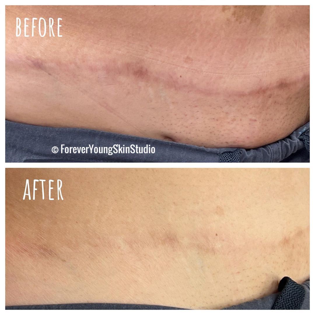 A before and after photo of a person 's skin