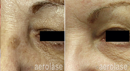 A before and after photo of a woman 's face.