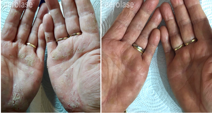 A before and after picture of a person 's hands with rings on them.