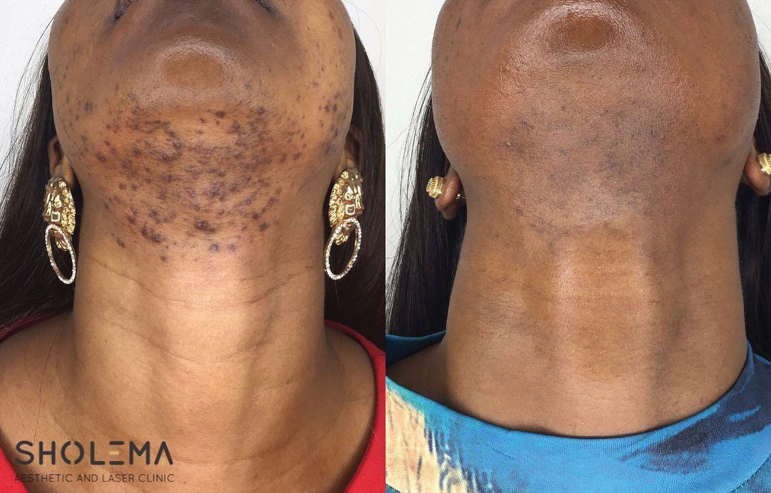 Close-up of two necks showing dark, patchy skin discoloration under the chin