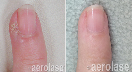 A before and after picture of a person 's nails.
