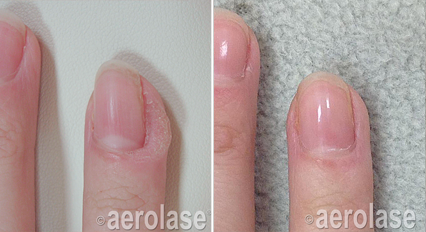 A before and after photo of a person 's nails.
