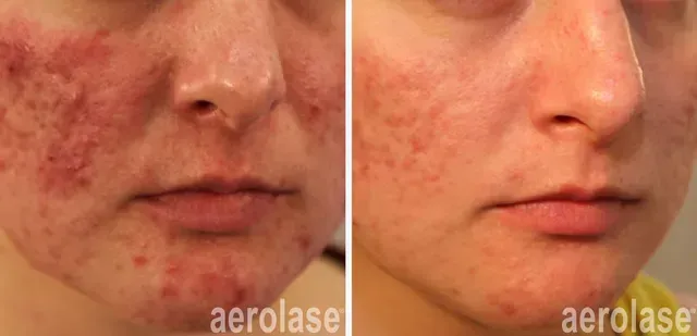 A before and after photo of a young man 's face with acne.