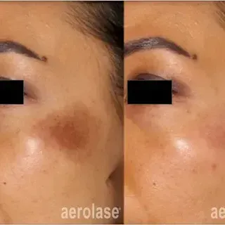A before and after photo of a woman 's face with dark spots.