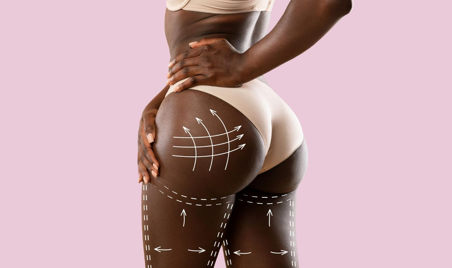 Person in nude underwear with surgical marking on legs and buttocks against pink background.