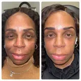 A before and after photo of a woman 's face with and without eyebrows.
