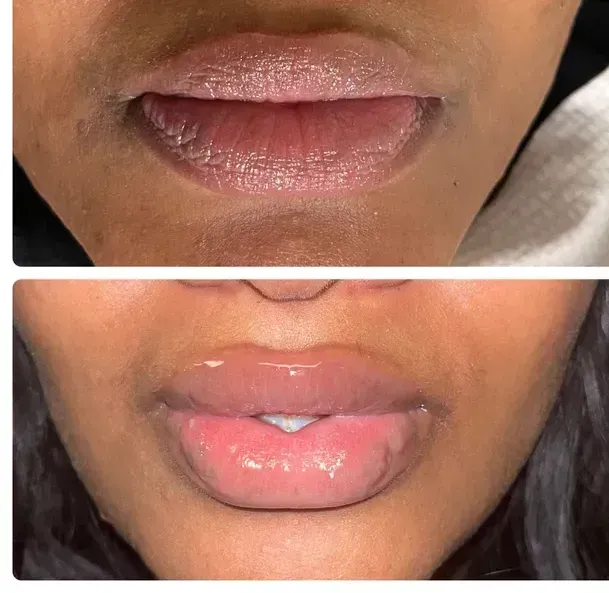 A before and after photo of a woman 's lips.