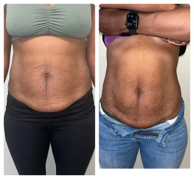 A before and after picture of a woman 's stomach