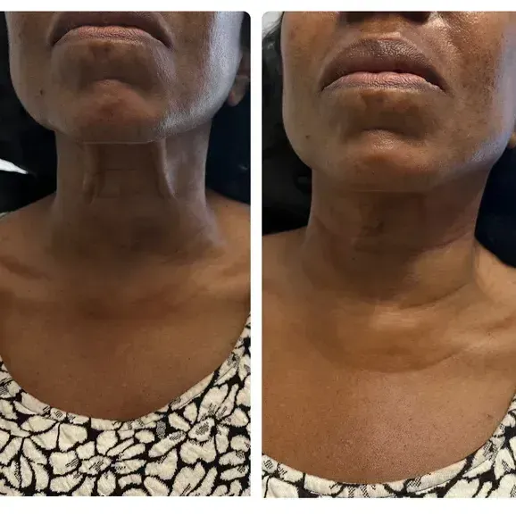 A before and after photo of a woman 's neck and neckline