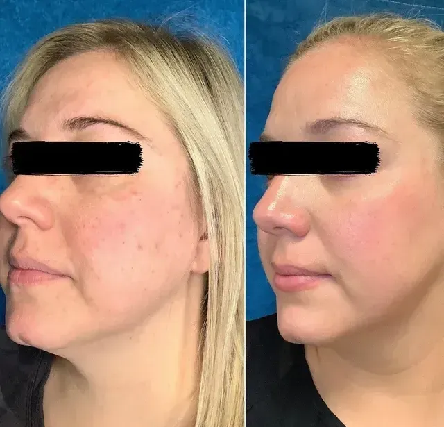 A before and after photo of a woman 's face