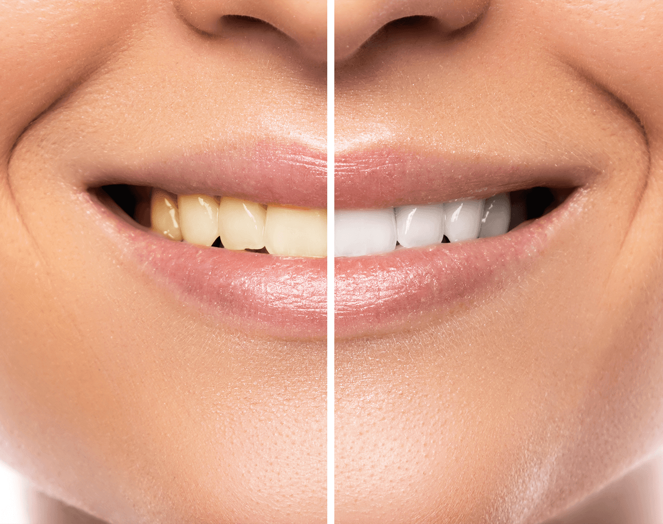 Teeth Whitening before and after