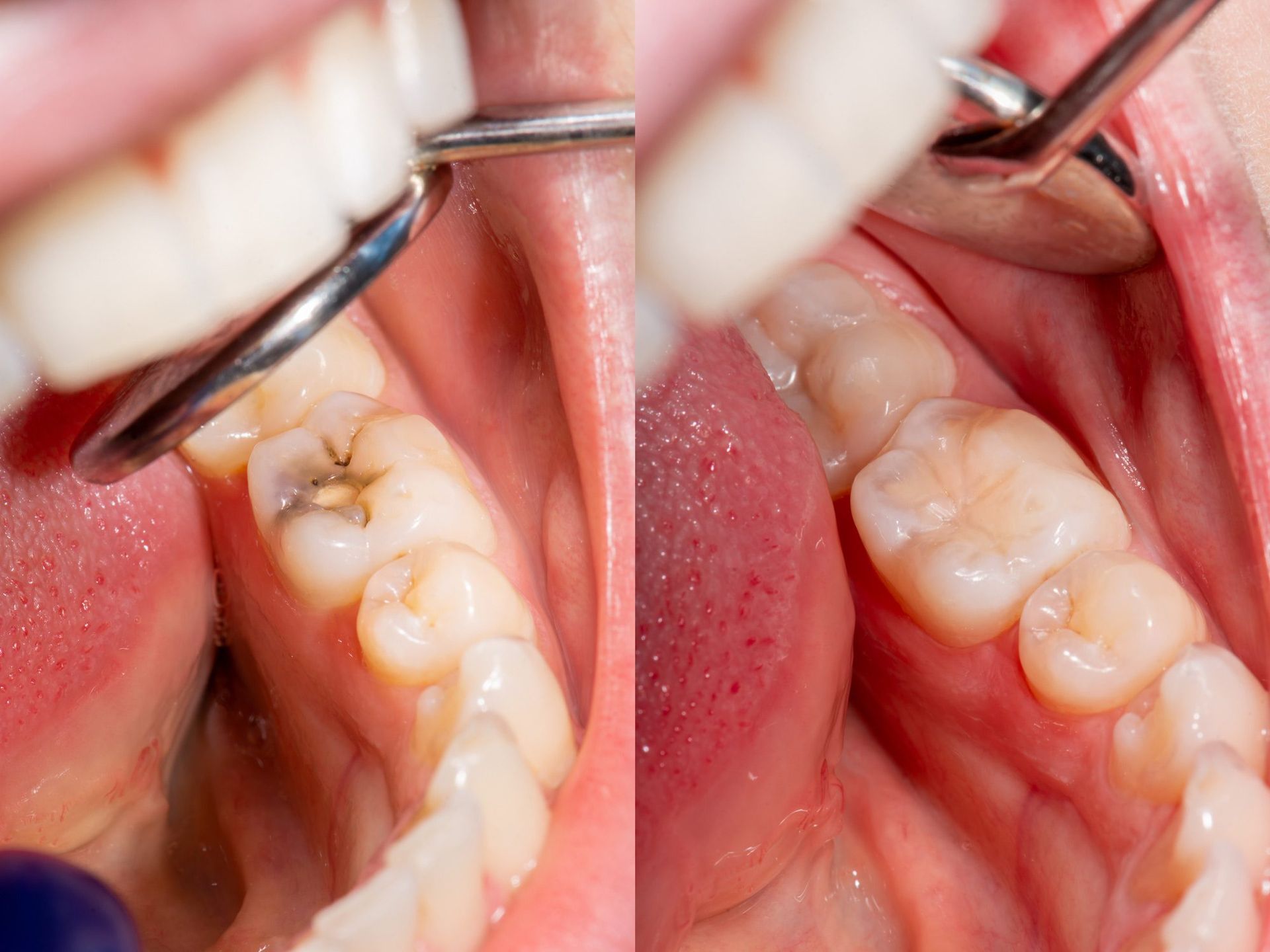 A before and after picture of a person 's teeth being examined by a dentist.