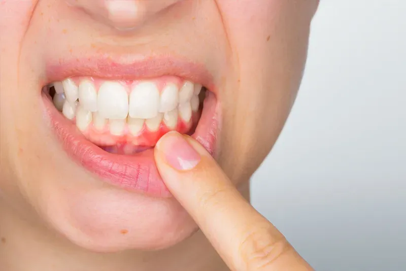 A close up of a woman 's mouth with a finger pointing at her gums.