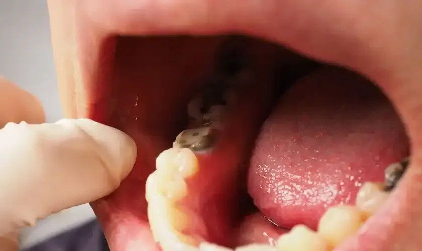 A close up of a person 's mouth with a tooth missing.