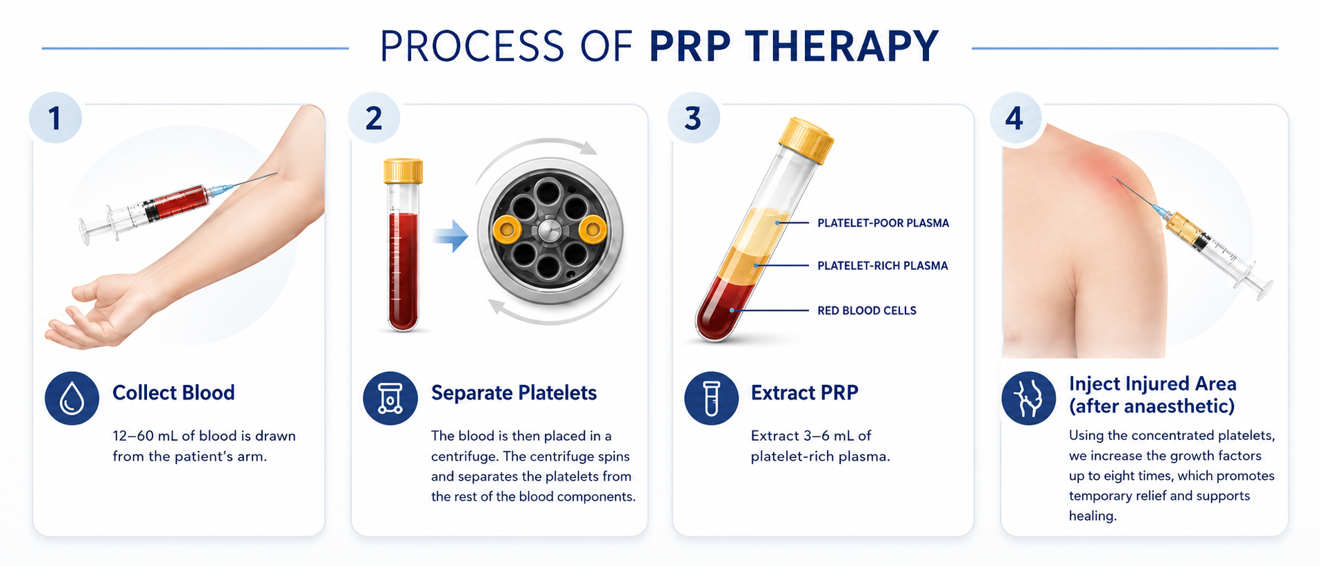 The PRP process in four steps: collect blood, separate the platelets, extract platelet-rich plasma, and inject the area under ultrasound guidance