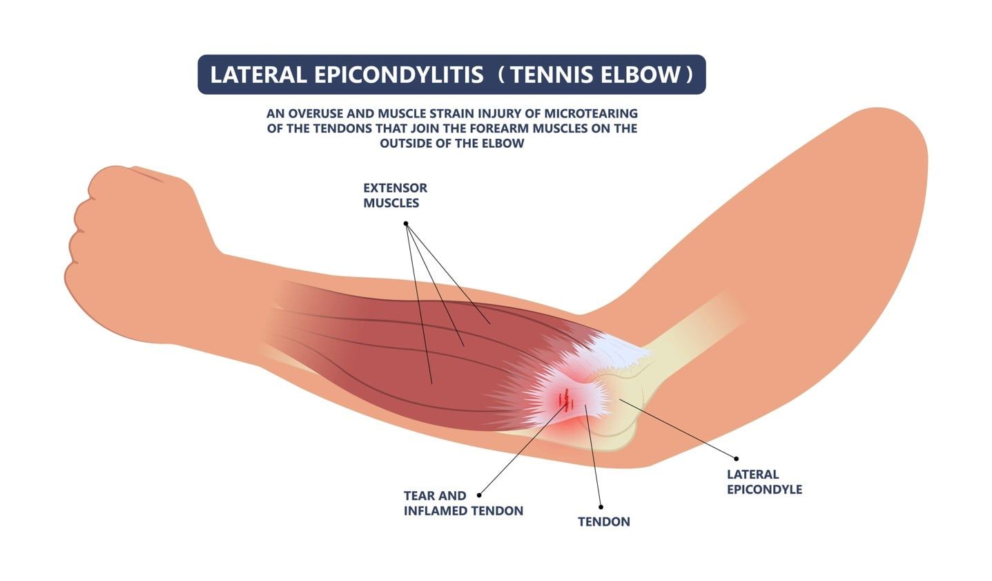 Tennis Elbow