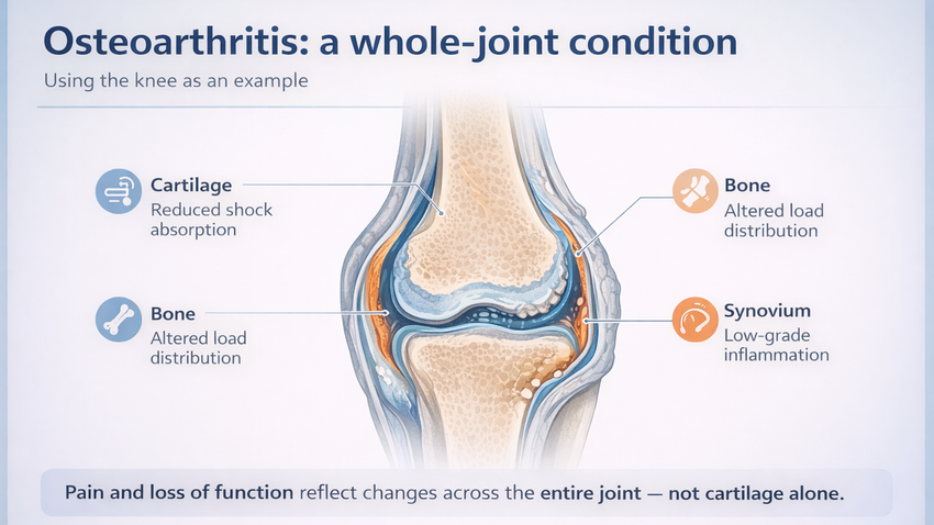 Osteoarthritise Image, conditions treated by specialists at Progressive Sports