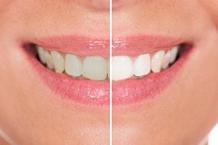 Teeth Whitening — Teeth in Johnstown, PA