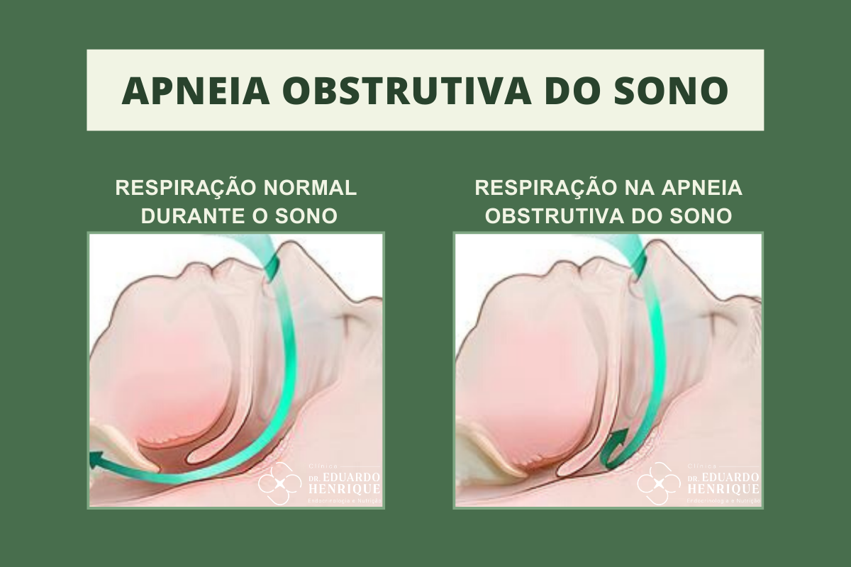 apneia-obesidade-dr-eduardo-henrique-endocrinologista-sao-paulo